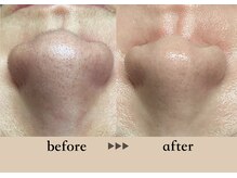 ソーヴ(SOLVE)/マツヤニフェイスワックス/毛穴