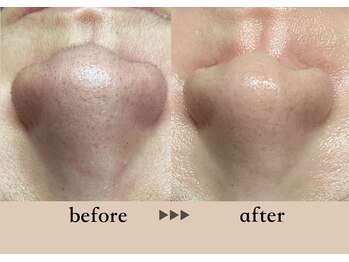 ソーヴ(SOLVE)/マツヤニフェイスワックス/毛穴