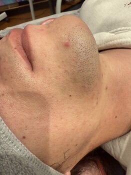 モア(MORE)の写真/ひげ脱毛で清潔感アップ！パーツ毎に選べるので、まずは気になる箇所から気軽に試してみませんか？