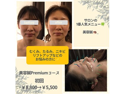 アキュリング(Aculing)の写真