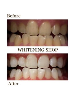 ホワイトニングショップ 倉敷店/【倉敷】セルフホワイトニング