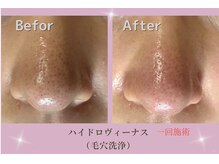 レガート(Legato)/黒ずみ解消♪毛穴洗浄ピーリング