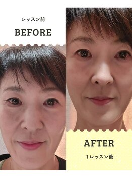 クローブ鍼灸院(CLOVE鍼灸院)/お顔の歪みに◎鍼灸＋表情筋トレ