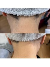 ルーラ(diva' LurA)/うなじ脱毛