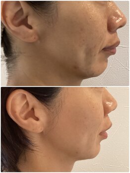 フォーユー 飯能店(Foryou)/劇的変化!綺麗な透き通る肌に!