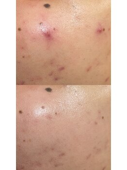 ラペカ(Lapeca)/REVIハーブピーリング/医療提携