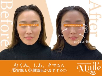 まいれ鍼灸院整骨院 整体院 草津院/美容鍼（むくみ/ほうれい線）