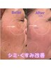 【最新光フェイシャル】シミ/毛穴/くすみ改善！美肌体験60分￥22,000→￥11,000
