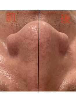 サムライの美/黒詰まりしている角栓を除去！
