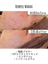 ハオン(HAON)/ハーブピーリング/ニキビ/毛穴