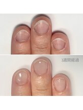 リモネイル(Rimo nail)/爪育成、深爪改善