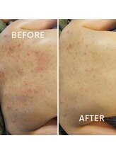 水光ピールスキン/ボディーピーリング効果は最強