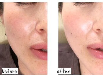 シフク鍼灸整体院/30代女性(加工なし)