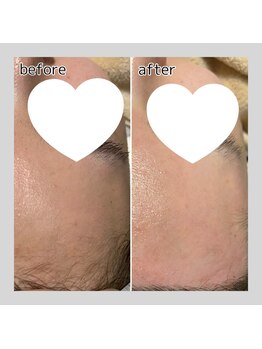 アデル 久留米(ADEL)/《部分》おでこワックス