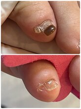 リネイル 長浜(Re-na-iL)/フットネイルケア¥7000