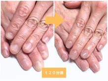 インブロッサム(imblossom)/深爪矯正/ナチュラルカラー