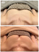 美人バスト 小倉店/バストアップ◇症例◇