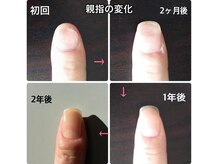自爪ケア専門サロン イニュラ(inula)/親指の凹凸のお悩み