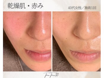 スリースリー(THREE THREE)/乾燥・赤みケア