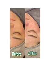 ディア(Deer)/韓国マイクロウェーブ×鍼灸