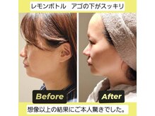 アン 銀座(ann)/レモンボトル【1回目の効果】