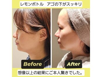 アン 銀座(ann)/レモンボトル【1回目の効果】