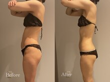 エステティック ミュー(Esthetic MiEUX)/全身痩せコース5回目