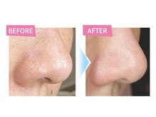 サロンエム 西荻窪(salon M)/毛穴洗浄