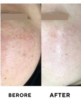 ゼロ(ZERO)/シミシワ肌質改善スペシャル