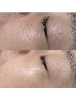 アミュレット(amulette)/1回の施術でお肌のキメが滑らか