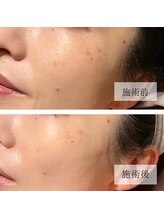 ル キヤ アイスペシャリテ ハービスENT店/【ビフォーアフター】シミ改善