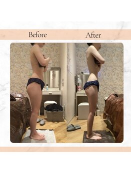 ソウイボディ 川崎本店(Sou-i body)の写真/当店人気NO,1☆結果重視!本気痩身【ハイパーナイフかけ放題+脂肪燃焼90分x2回¥13000】筋膜リリースも♪