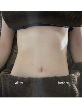 ラヴィリス(Raviliss)/リンパマッサージ(お腹比較写真)