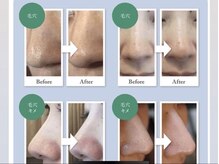 ティエラ(Tierra)/【毛穴洗浄】ビフォーアフター