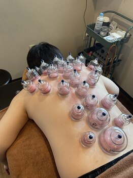 ラックス鍼灸 整体院(Lachs鍼灸 整体院)/カッピングの様子