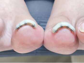 アット エル(at...L)の写真/【巻き爪を直したい・爪のコンプレックス・かみ癖をなおしたいetc】優しく丁寧な施術で爪のお悩みを解消☆