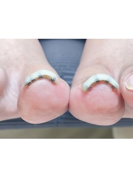 爪の悩みを解消できる（ケア含む）