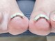 アット エル(at...L)の写真/【巻き爪を直したい・爪のコンプレックス・かみ癖をなおしたいetc】優しく丁寧な施術で爪のお悩みを解消☆