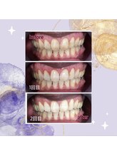 ホワイトニングプラス(Whitening+)/男性も増えてます