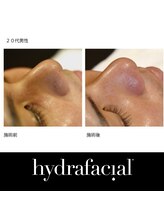 シーボン コンセプトショップ/ハイドラフェイシャル施行事例