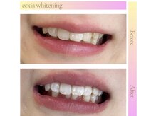 エクシア ホワイトニング 伊勢崎店/