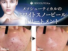 ケアナ 梅田店(CareNa)の雰囲気（【スノーピール】ハーブピーリングが苦手な方はぜひ乳酸ピール）