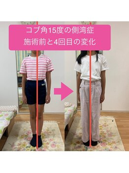 エスコート芦屋サロン/小学生の側湾