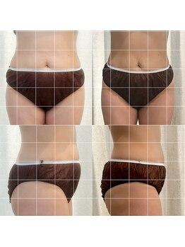 ココロ(COCORO)/脂肪冷却