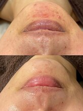 ビエン(bien)/口周りの繰り返すニキビケア