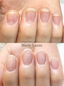マリーロール 梅田店(Marie Laure)/自爪育成/深爪矯正/ネイルケア