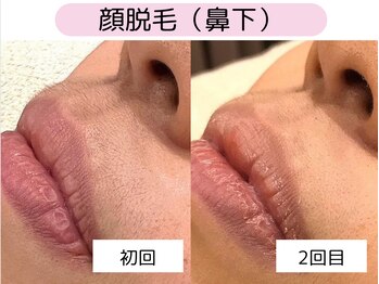 ウルル 四日市駅前店(ULULU)/鼻下脱毛