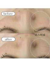 ケアプラス/頬の赤み改善