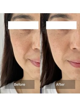 ハリオン 中目黒(HARI-ON)/Before After / 施術1回