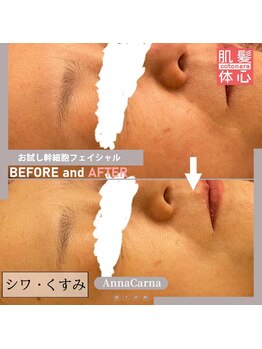 アンナカルナ(AnnaCarna)/目の周りの印象が変わると?